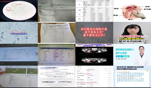 前列腺白细胞2+加原因 - 汕头前列腺为什么白细胞2+