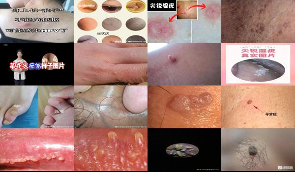 汕头男性*医院哪里比较好 - 汕头男性尖锐疣图片