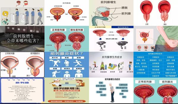 汕头前列腺炎 - 汕头前列腺增生有什么症状和危害性