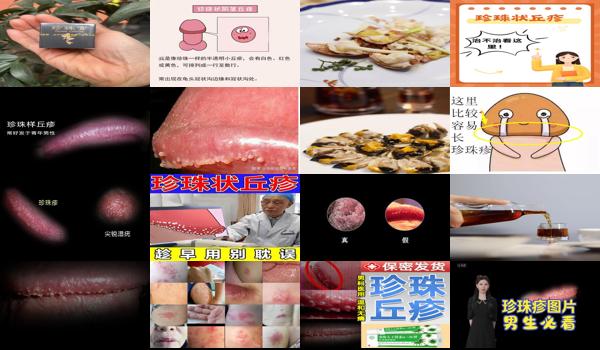 汕头珍珠状疱疹疫苗价格 - 汕头珍珠状疱疹