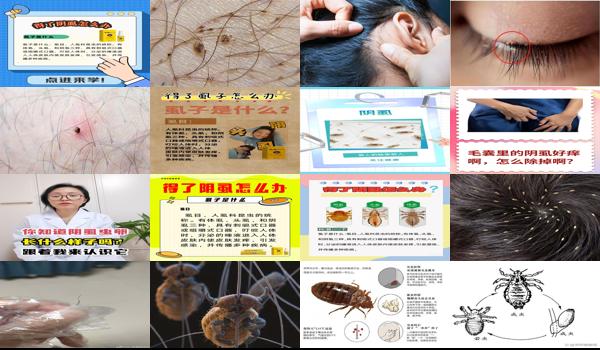 阴虱头虱 - 汕头阴虱 怎么来的