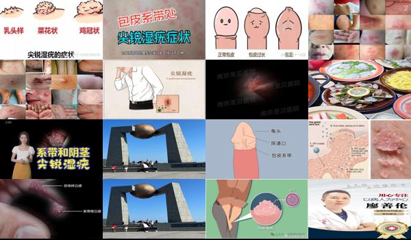 包皮系带 尖锐 - 汕头尖锐长包皮系带