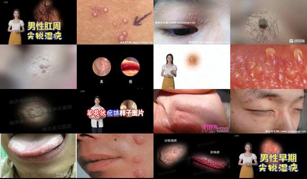 汕头男科性疾病 - 汕头男性尖锐湿疣初期高清图