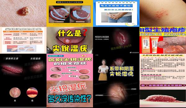 汕头治疗尖锐*好的医院 - 汕头龟头尖锐性湿尤