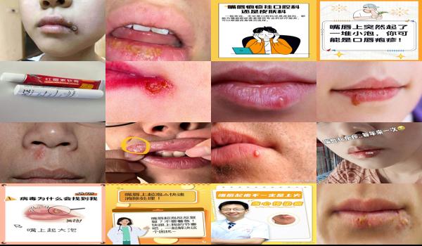 汕头唇炎医院哪家好 - 汕头口唇疱疹该怎么办