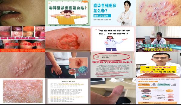 汕头生殖科医院 - 汕头得了生殖疱疹怎么办