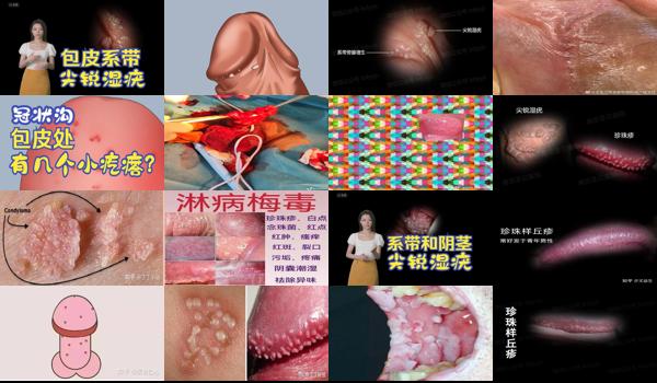 汕头割包茎哪家医院好 去哪 - 汕头初期包皮尖锐湿疣图片