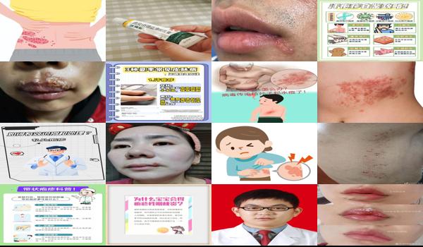 男士下面疱疹图片大* - 汕头男生下体疱疹怎么处理