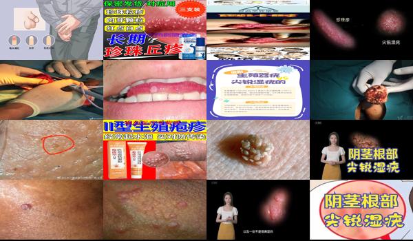 汕头*感染多人死亡 - 汕头鸡巴感染尖锐