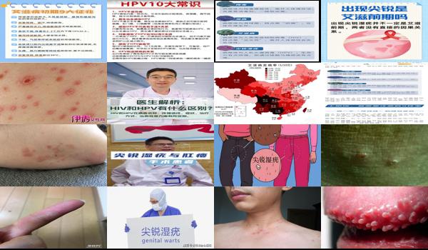 尖疣湿锐是艾滋病吗 - 汕头尖锐湿疣是艾滋病前兆