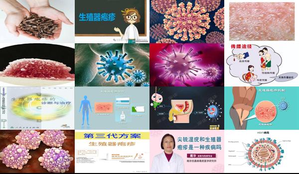 生殖疱疹有异味什么原因 - 汕头生殖器疱疹有异味吗