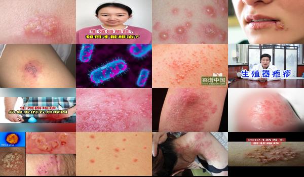 生殖疱疹费用价格 - 汕头得了生殖疱疹是不是一辈子都废了