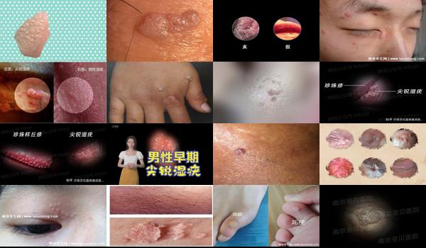男士尖锐湿优是hpv几? - 汕头男性尖锐湿尤图初期图片 疙瘩