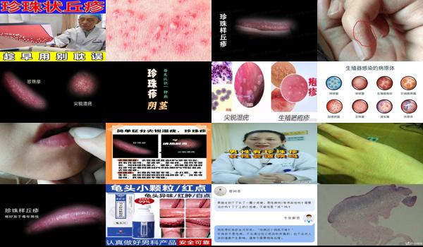汕头珍珠疱疹疫苗价格 - 汕头珍珠疱疹