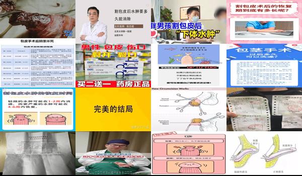 割包头几天恢复 - 汕头割包皮后多久才消肿