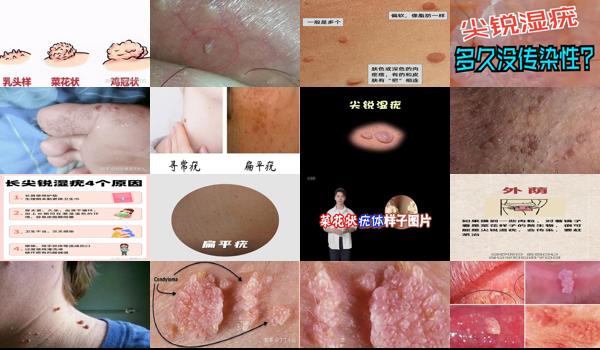 细长的肉疙瘩是尖锐 - 汕头长小肉粒*是尖锐湿疣么