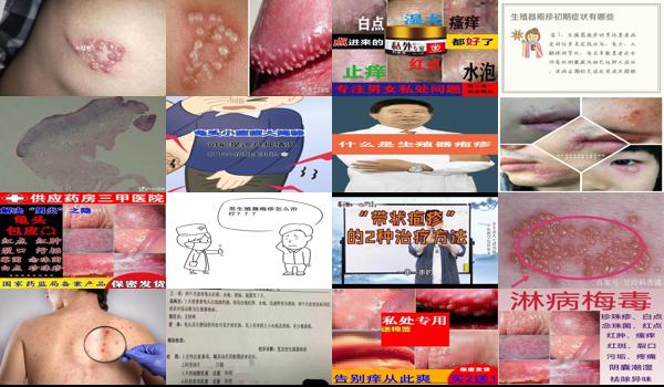 汕头*好的割包皮医院是哪家 - 汕头龟头疱疹怎么治疗