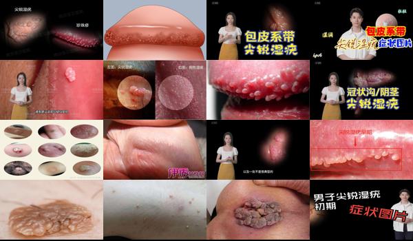 汕头男性*医院哪里比较好 - 汕头尖锐男性早期症状