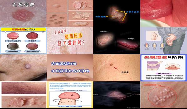 汕头尖锐小丘疹疫苗 - 汕头尖锐小丘疹