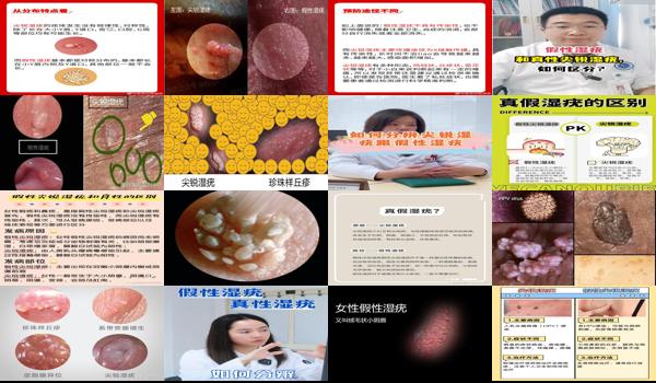 汕头假烟*新消息 - 汕头假性尖锐和真性区别图