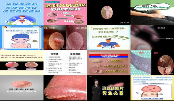 男性珍珠疹和尖锐湿疹的区别 - 汕头男性珍珠疹与尖锐湿疣外观区别
