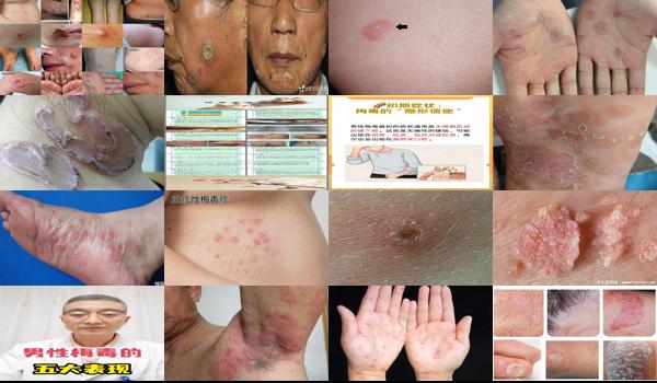 男性 梅毒 - 汕头男性生殖梅毒是什么症状