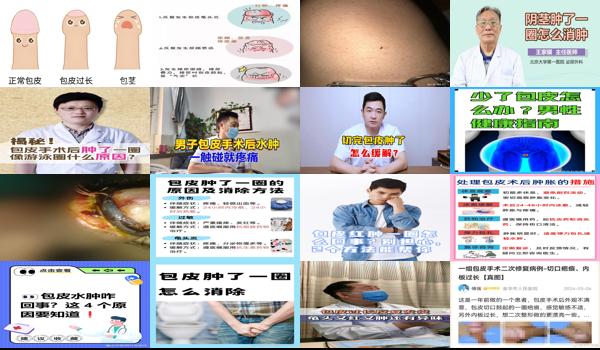 包皮肿了一圈怎么办 - 汕头包皮肿了一圈