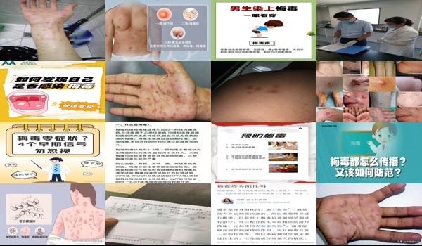 怎么看自己是不是中了梅毒 - 汕头怎么才知道自己中了梅毒