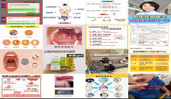 疱疹性咽颊炎传染路径 - 汕头疱疹性咽颊炎传染途径