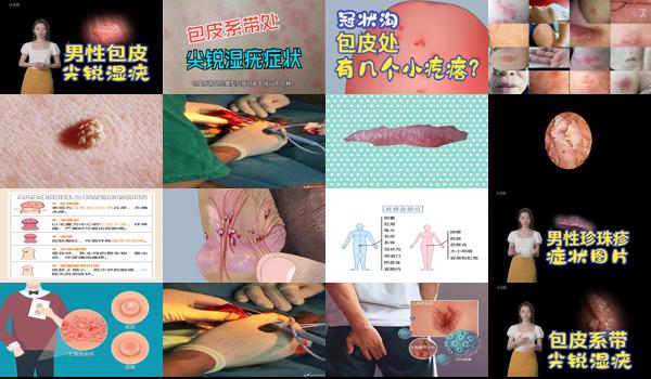 包皮尖疣湿早期症状图片 - 汕头包皮 白点 尖锐湿疣 图片