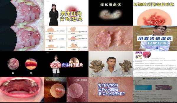 尖疣湿锐复发* - 汕头尖锐湿疣桂复发吗