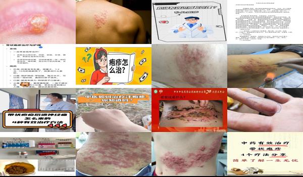 汕头有带状疱疹疫苗吗 - 汕头如何*治疗疱疹