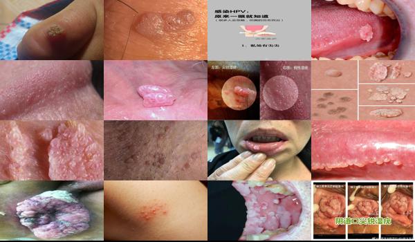 汕头 hpv - 汕头尖锐湿疣刚长出来图片