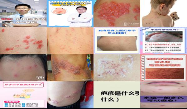婴儿疱疹是怎么引起的? - 汕头婴幼儿疱疹怎么引起的
