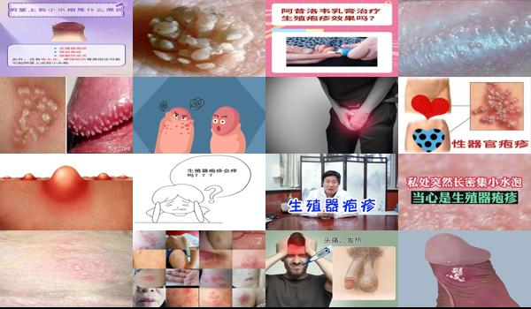 阴径疱疹怎么根治 - 汕头阴茎疱疹严重吗