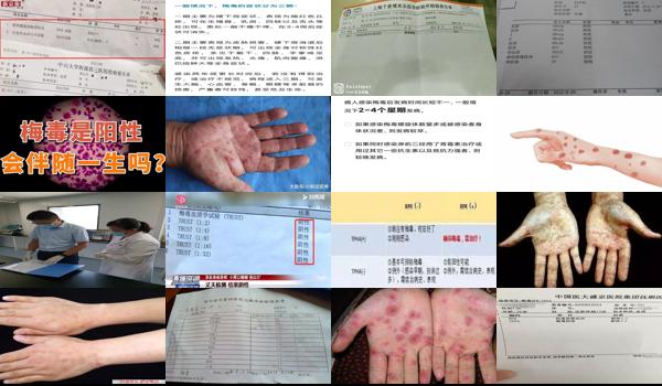 汕头尿检能查出梅毒吗多少钱 - 汕头尿检能查出梅毒吗