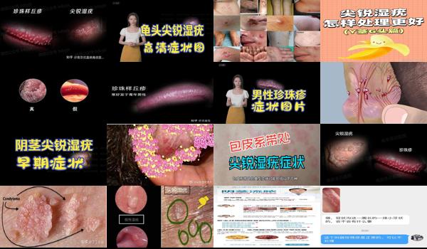 汕头治疗尖锐*好的医院 - 汕头尖锐湿疣龟头
