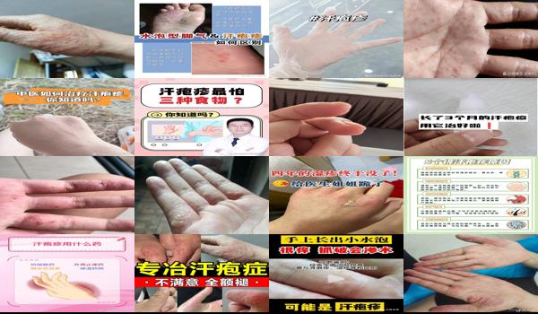 头皮汗疱疹 - 汕头汗疱疹怎么治好