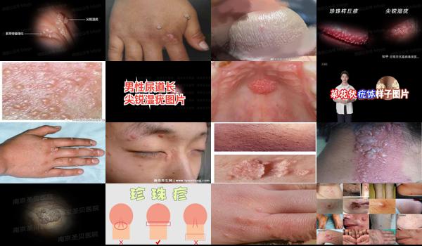 汕头 hpv - 汕头尖锐湿疣症状图片男