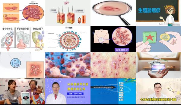 生殖疱疹初发多久能愈合 - 汕头生殖器疱疹刚发作是什么样