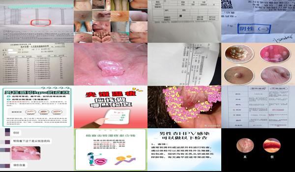 汕头市hpv检查 - 汕头怀疑得了尖锐湿疣怎么检查