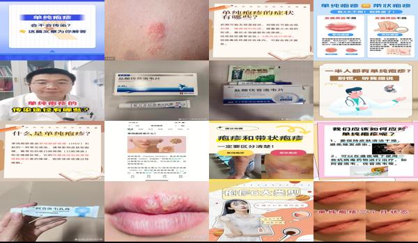 头部单纯疱疹症状 - 汕头单纯疱疹怎么治