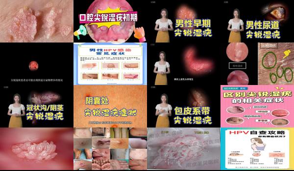 汕头看扁平疣的医院在哪里 - 汕头尖锐湿疣什么症状