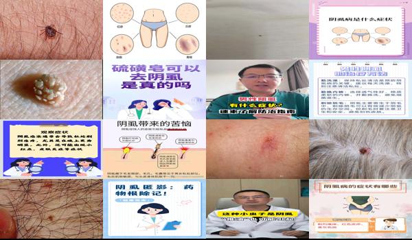 阴虱头虱体虱图片 - 汕头阴虱症状