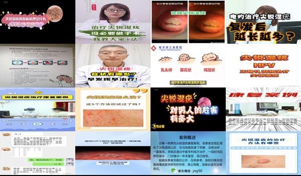 汕头治疗尖锐*好的医院 - 汕头那里治疗尖锐湿疣*好