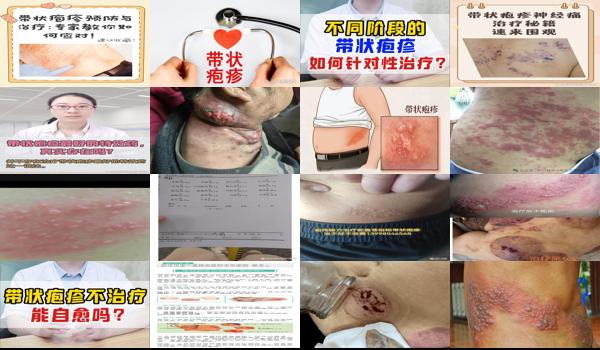 汕头有带状疱疹疫苗吗 - 汕头带状疱疹如何治疗