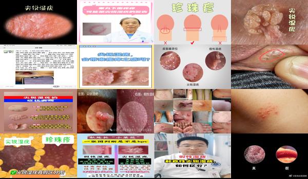 汕头男性*医院哪里比较好 - 汕头男性尖锐锐湿疣有假性的吗