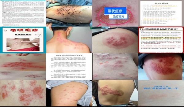 汕头有带状疱疹疫苗吗 - 汕头疱疹咋治疗好的快
