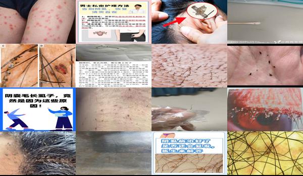 男性阴虱感染 - 汕头男性得阴虱病的样子