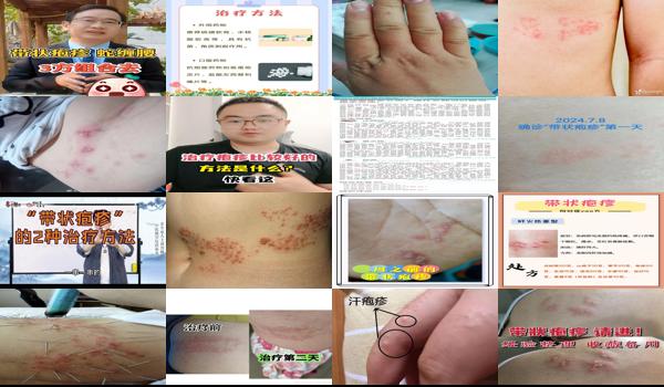 汕头怎么治 - 汕头疱疹治疗*好的方法